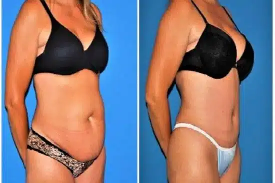 how much is a tummy Tuck in TURKEY