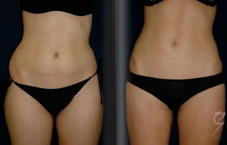 How Much Is a Tummy Tuck in TURKEY?
