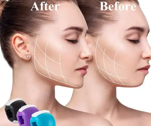 jawline implants
