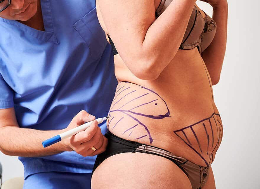 liposuction and tummy tuck