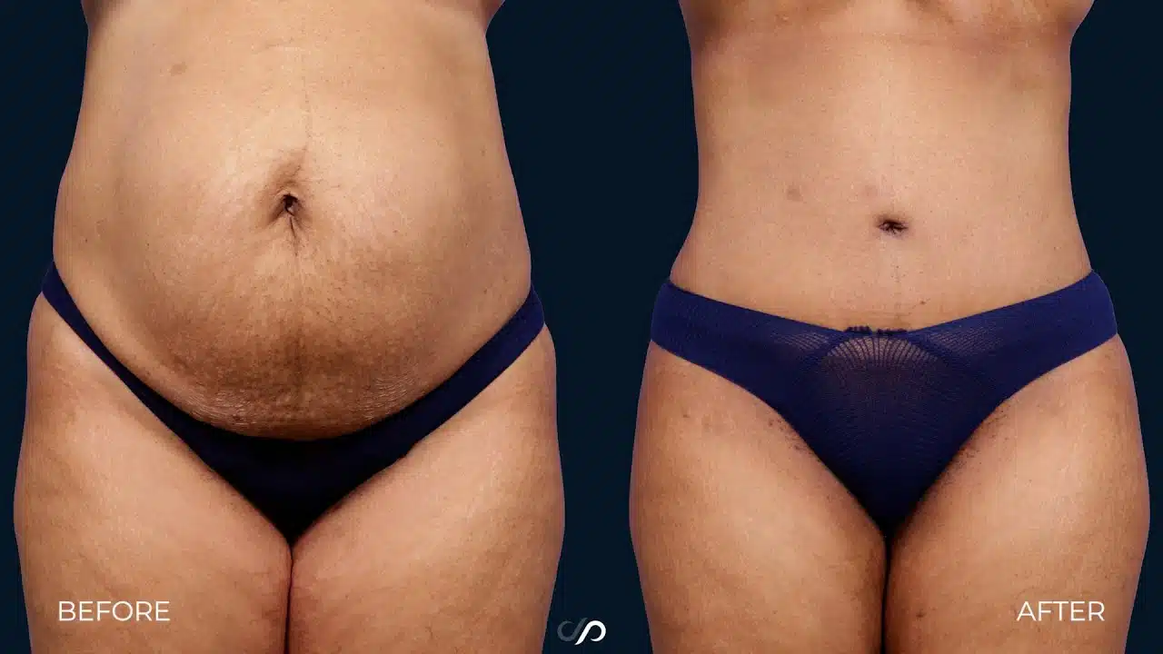 liposuction and tummy tuck
