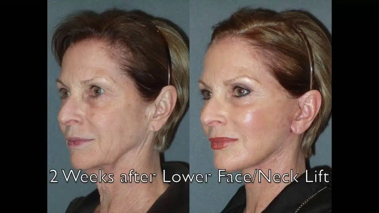 neck lift recovery time