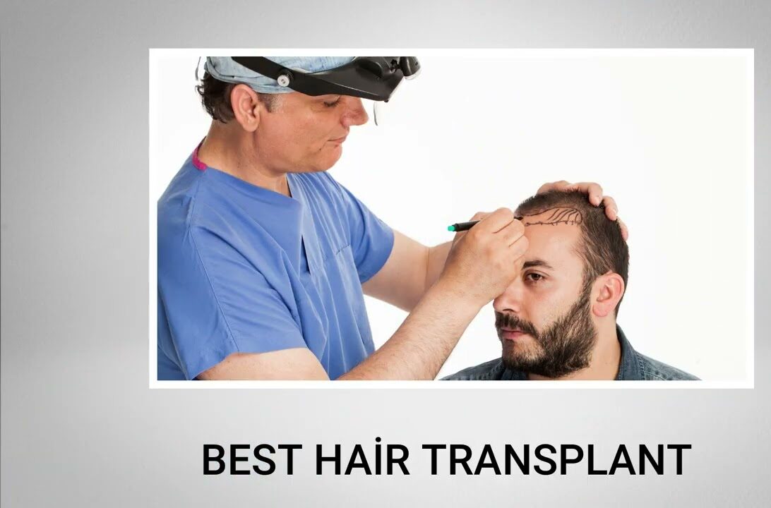 neograft hair transplant turkey
