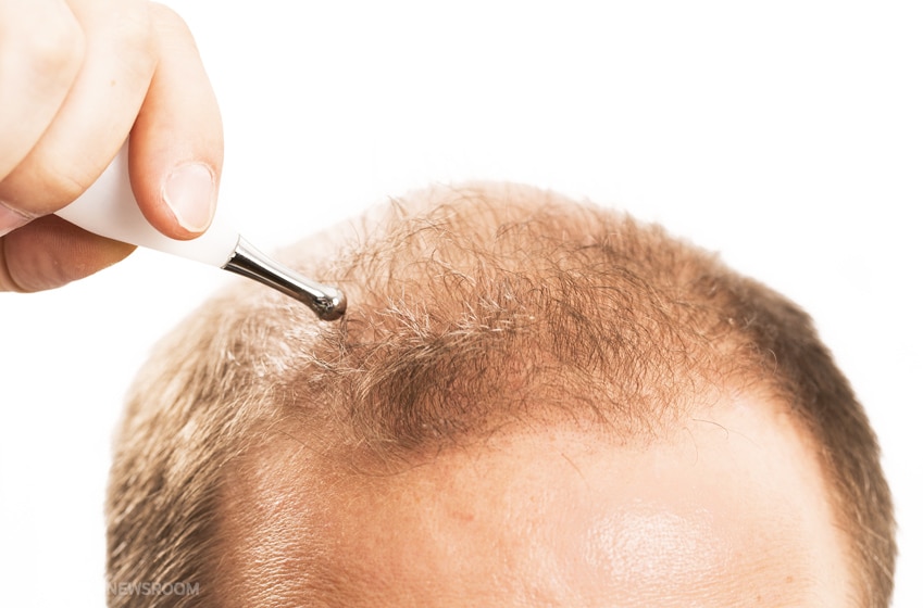 neograft hair transplant