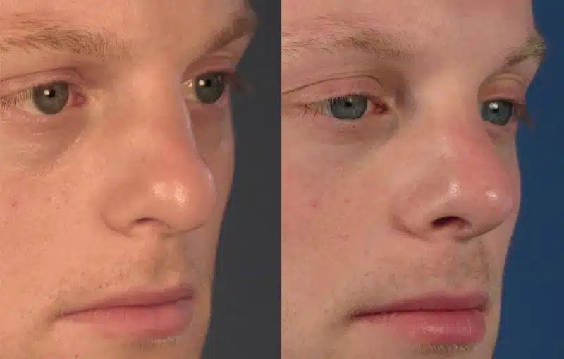 nose job bulbous tip cost