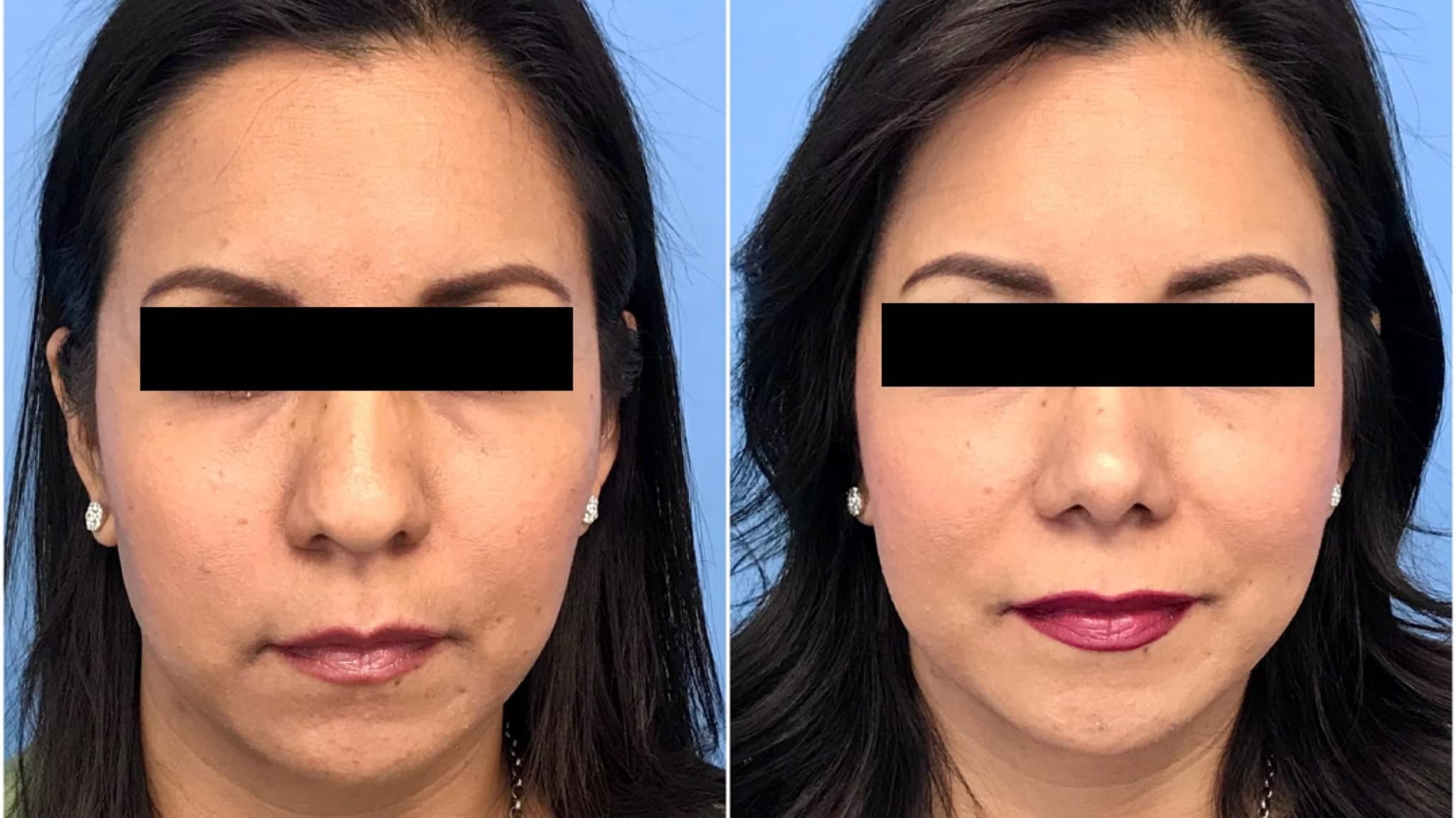 nose job bulbous tip cost