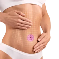 tummy tuck with muscle repair