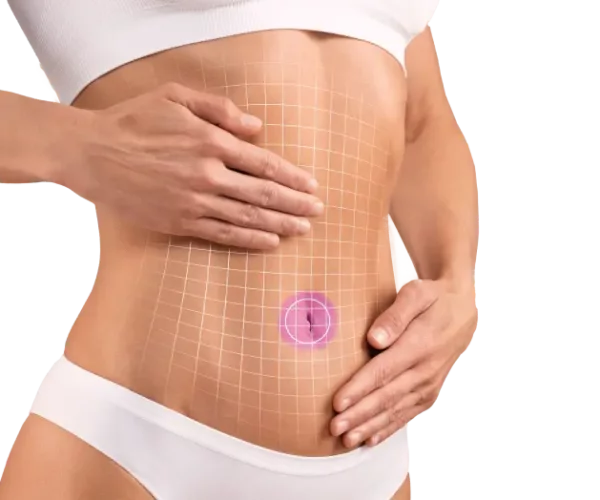 tummy tuck with muscle repair