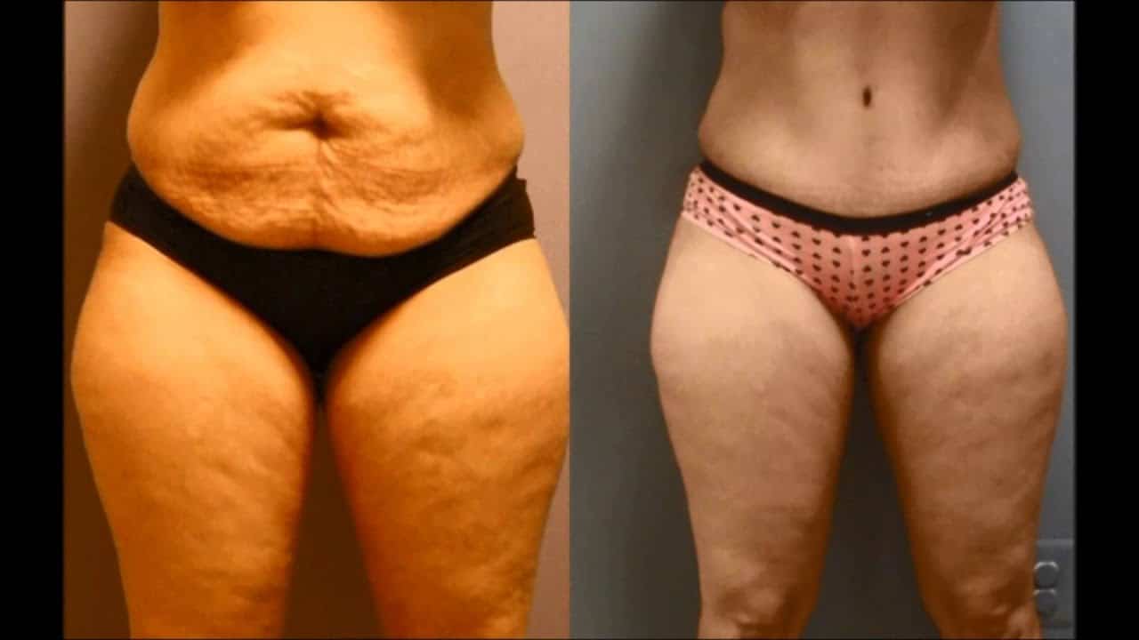 tummy tuck with muscle repair