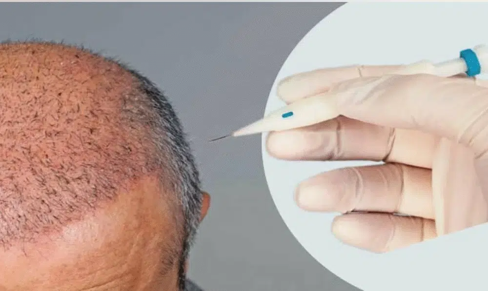 5000 Grafts Hair Transplant