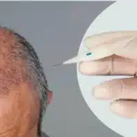 5000 Grafts Hair Transplant