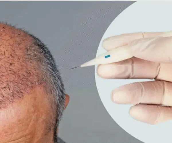 5000 Grafts Hair Transplant