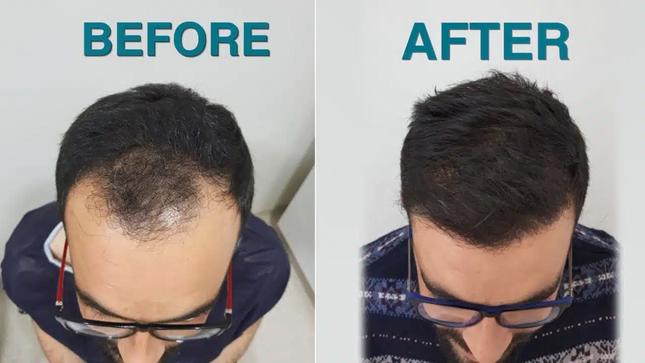 5000 grafts hair transplant cost usa