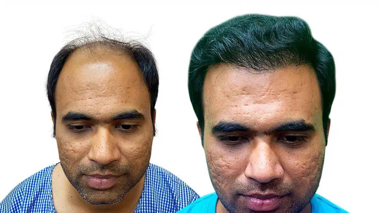 5000 grafts hair transplant cost usa