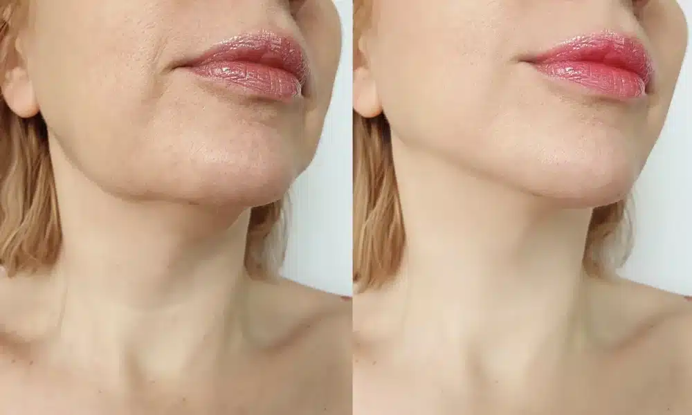 Chin Liposuction Cost