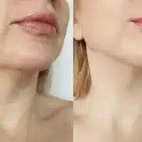 Chin Liposuction Cost
