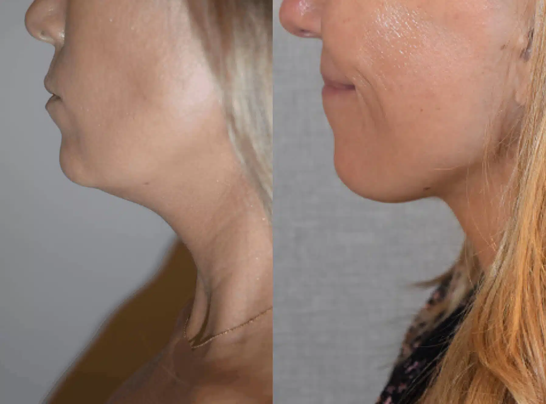 Chin Liposuction Cost