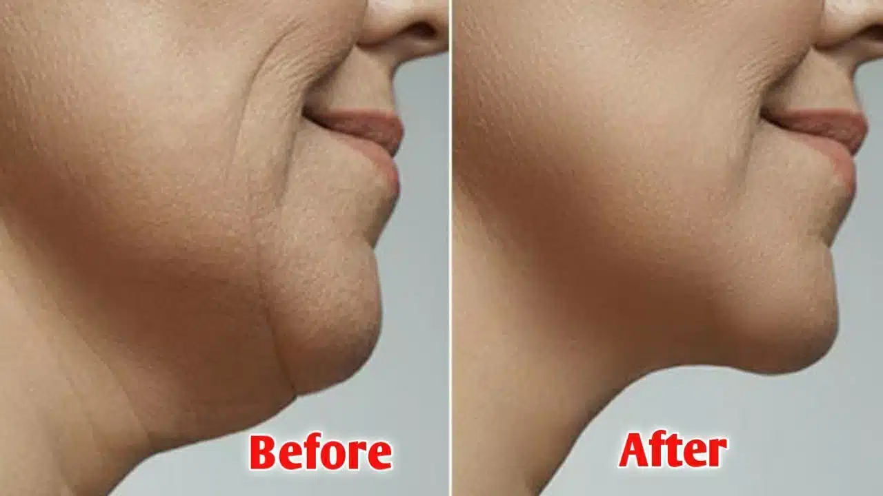 Chin Liposuction Cost