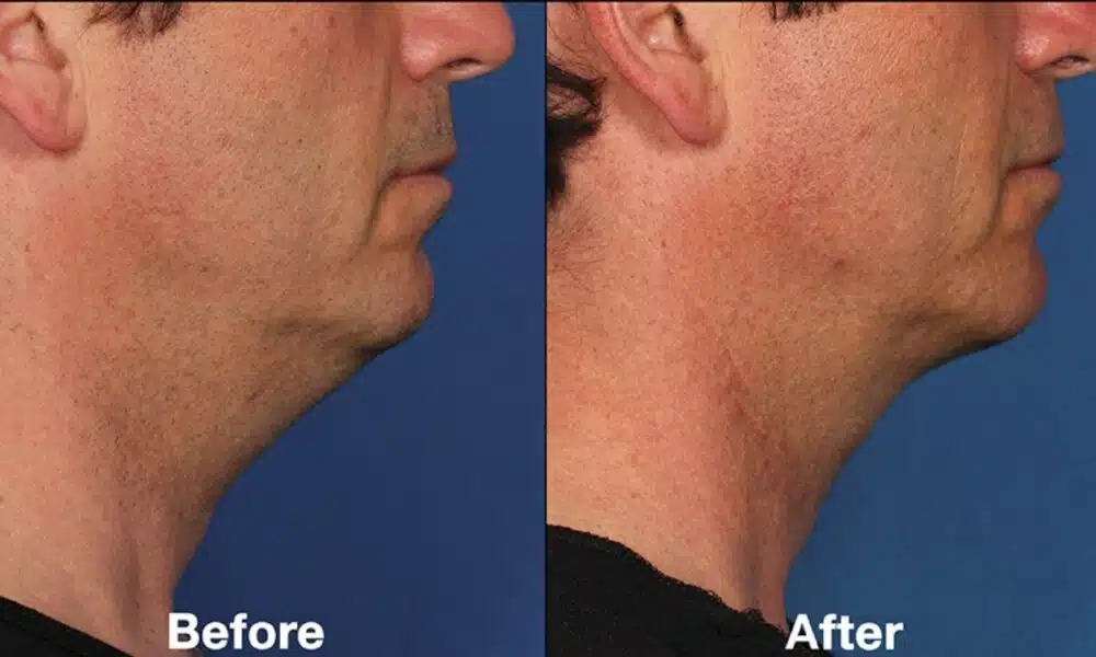Chin Reduction Surgery