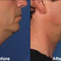 Chin Reduction Surgery