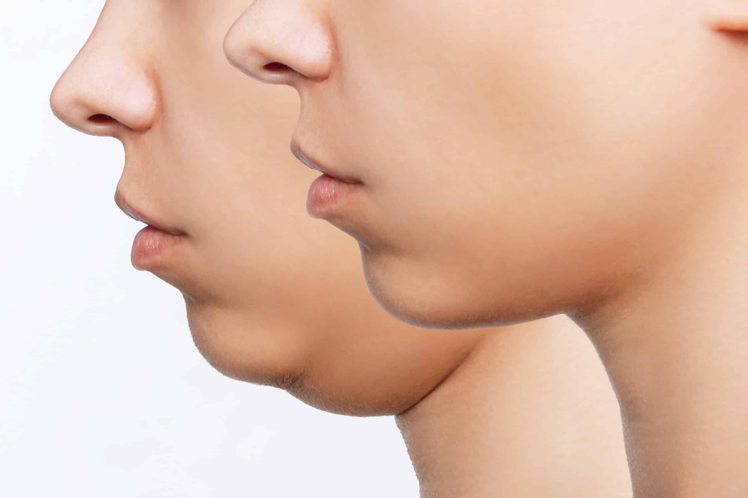 Chin Reduction Surgery