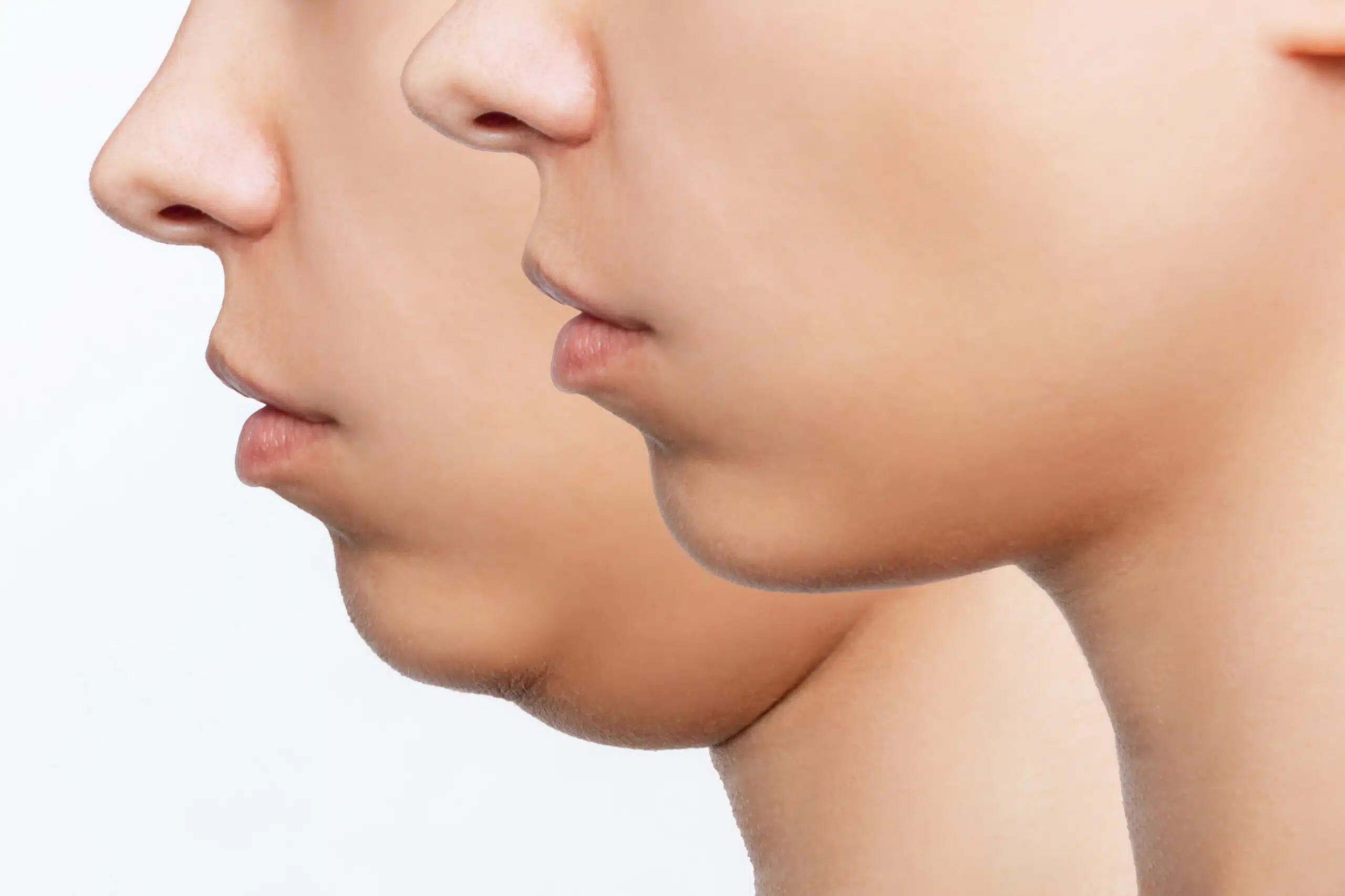 Chin Reduction Surgery