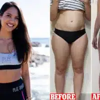 Fat Transfer for Skinny Legs Cost