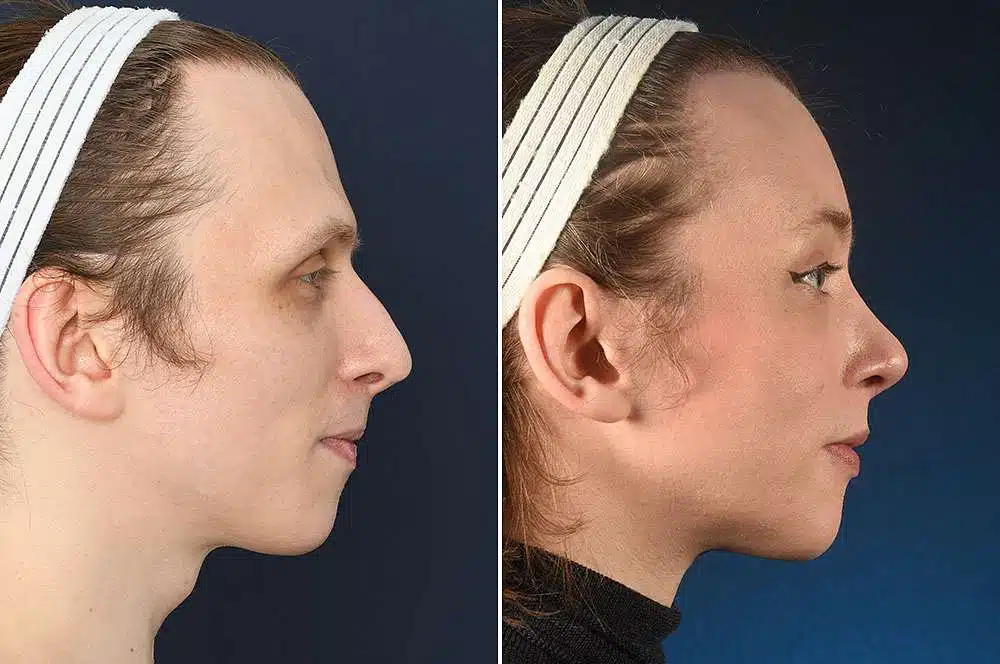 brow bone reduction