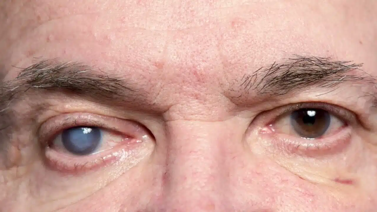 cloudy eyes