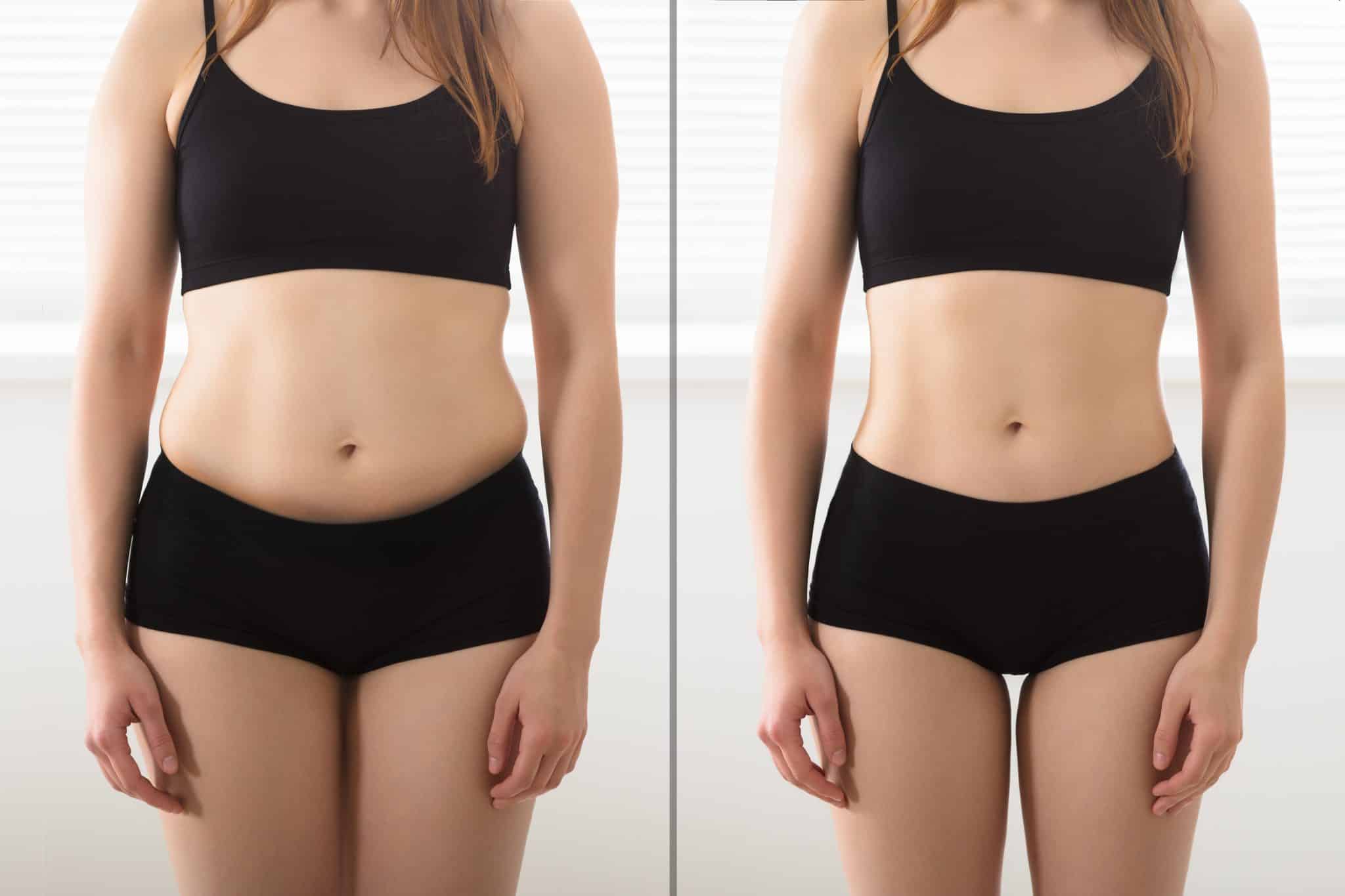 fat transfer for skinny legs cost