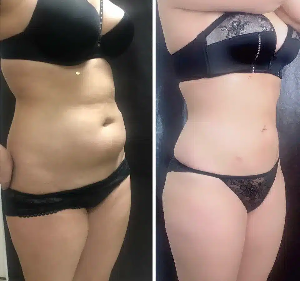 how much is a fat transfer from stomach to buttocks