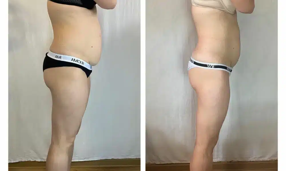 how much is a fat transfer from stomach to buttocks