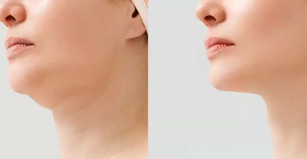 neck liposuction cost