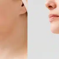 neck liposuction cost