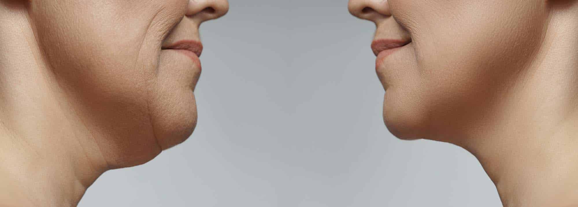 neck liposuction cost