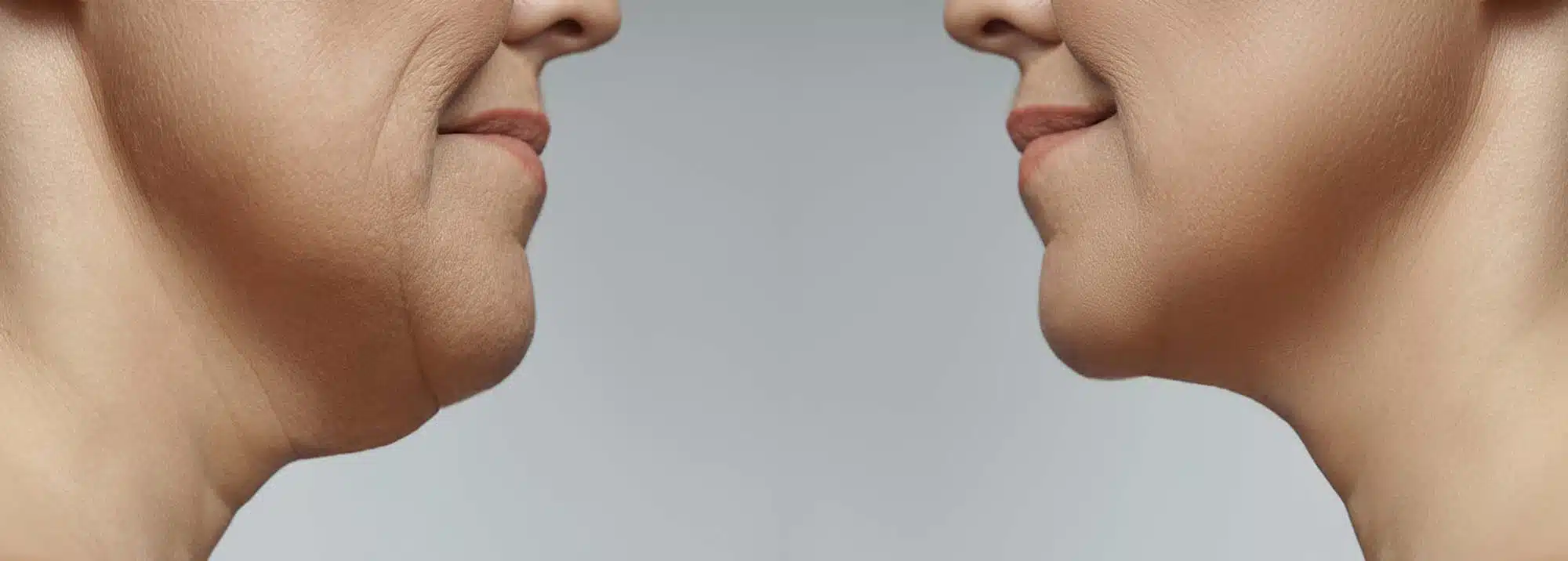 neck liposuction cost