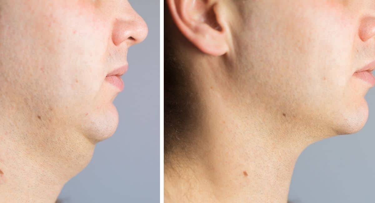 neck liposuction cost