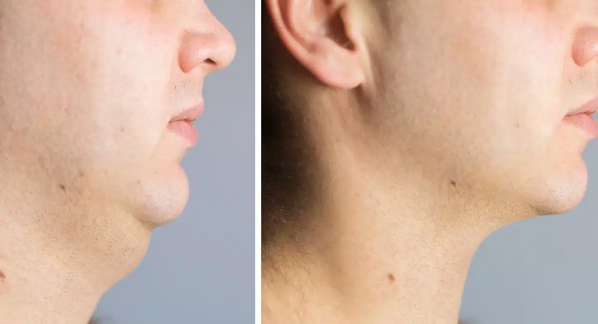 neck liposuction cost