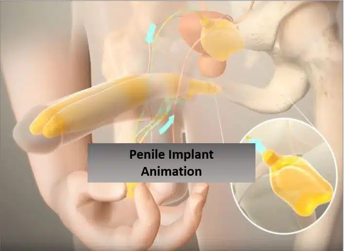 penuma implant cost