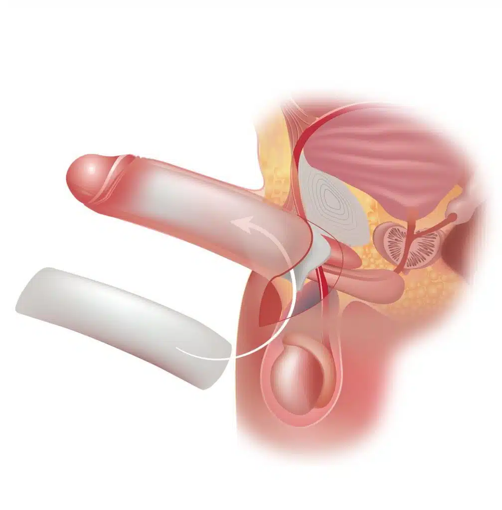 penuma implant cost