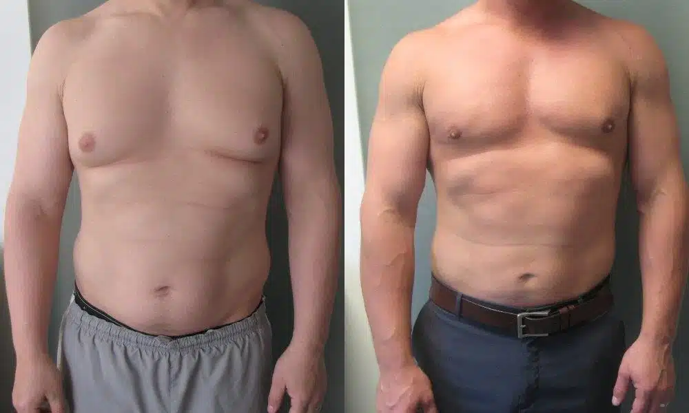 permanent male enlargement surgery cost