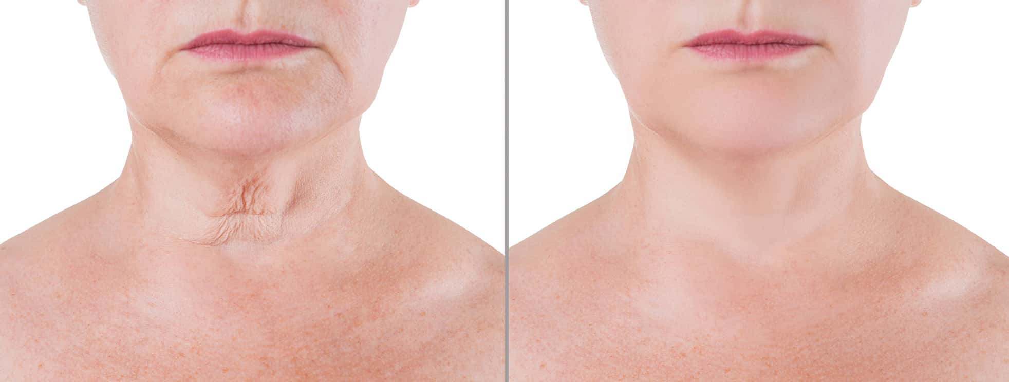 turkey neck surgery cost