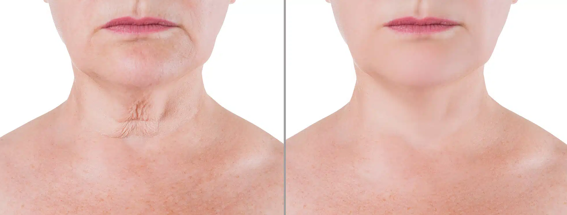 turkey neck surgery cost