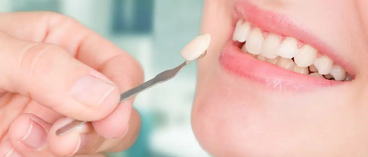 veneers in turkey price