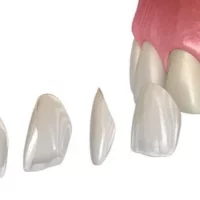 veneers in turkey price